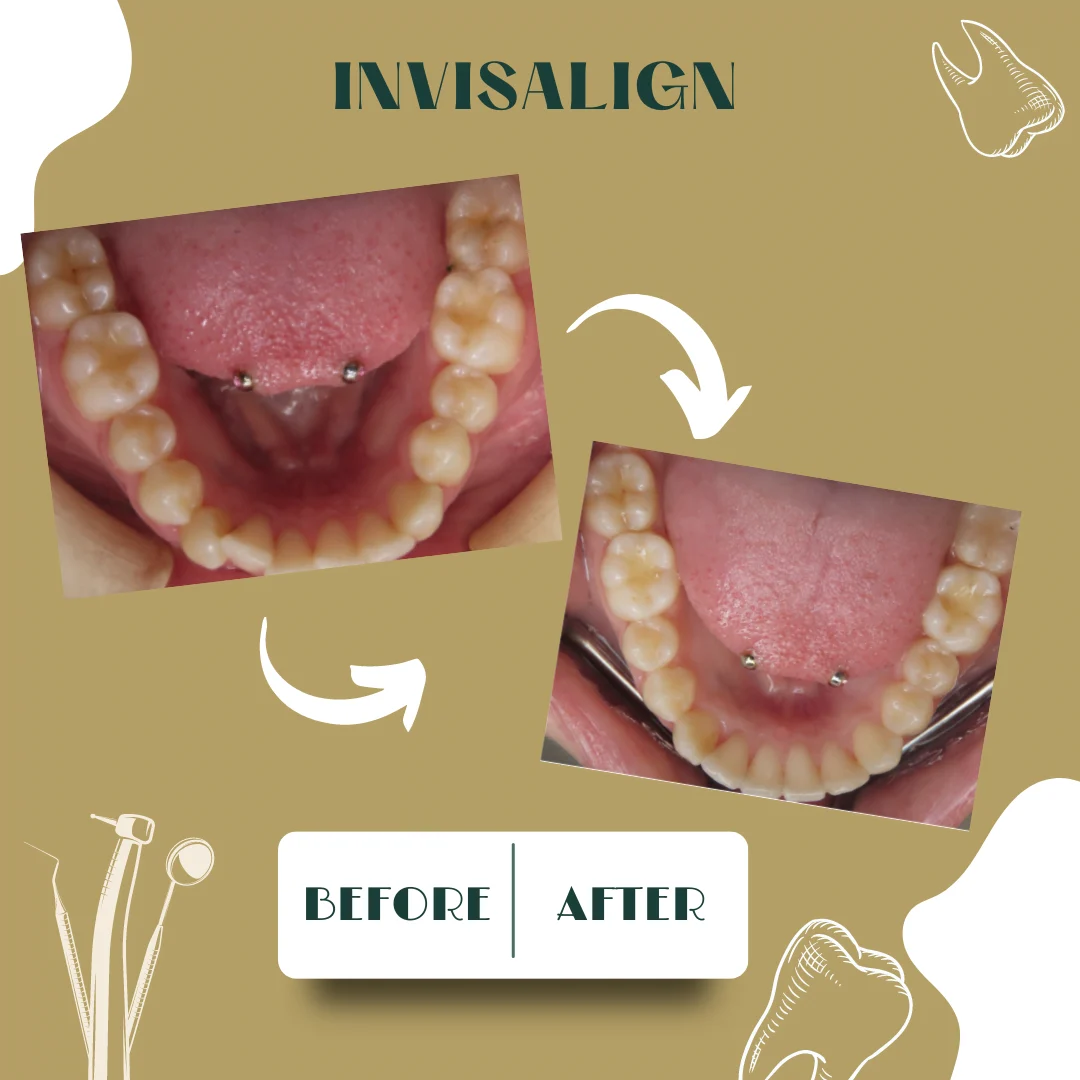 Dental case, before and after 13
