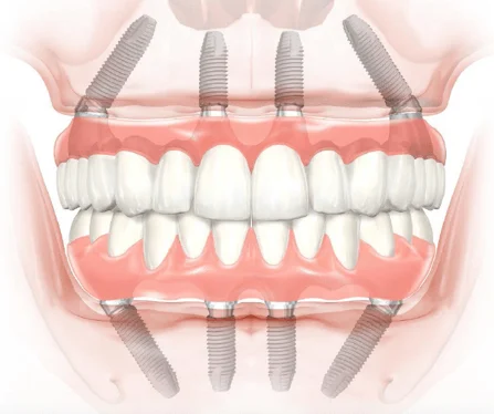 All-On-4 Dental Implants