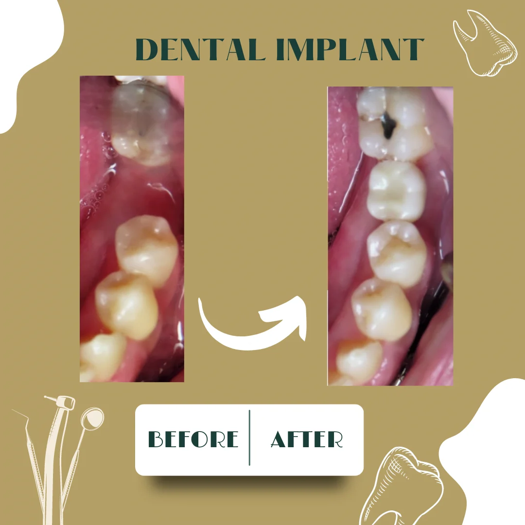 Dental case, before and after 23