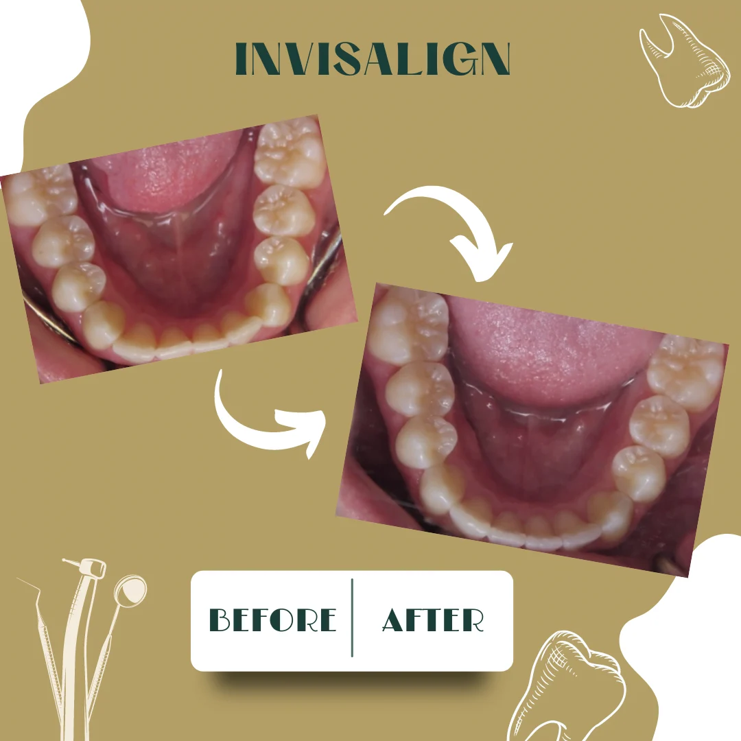 Dental case, before and after 10